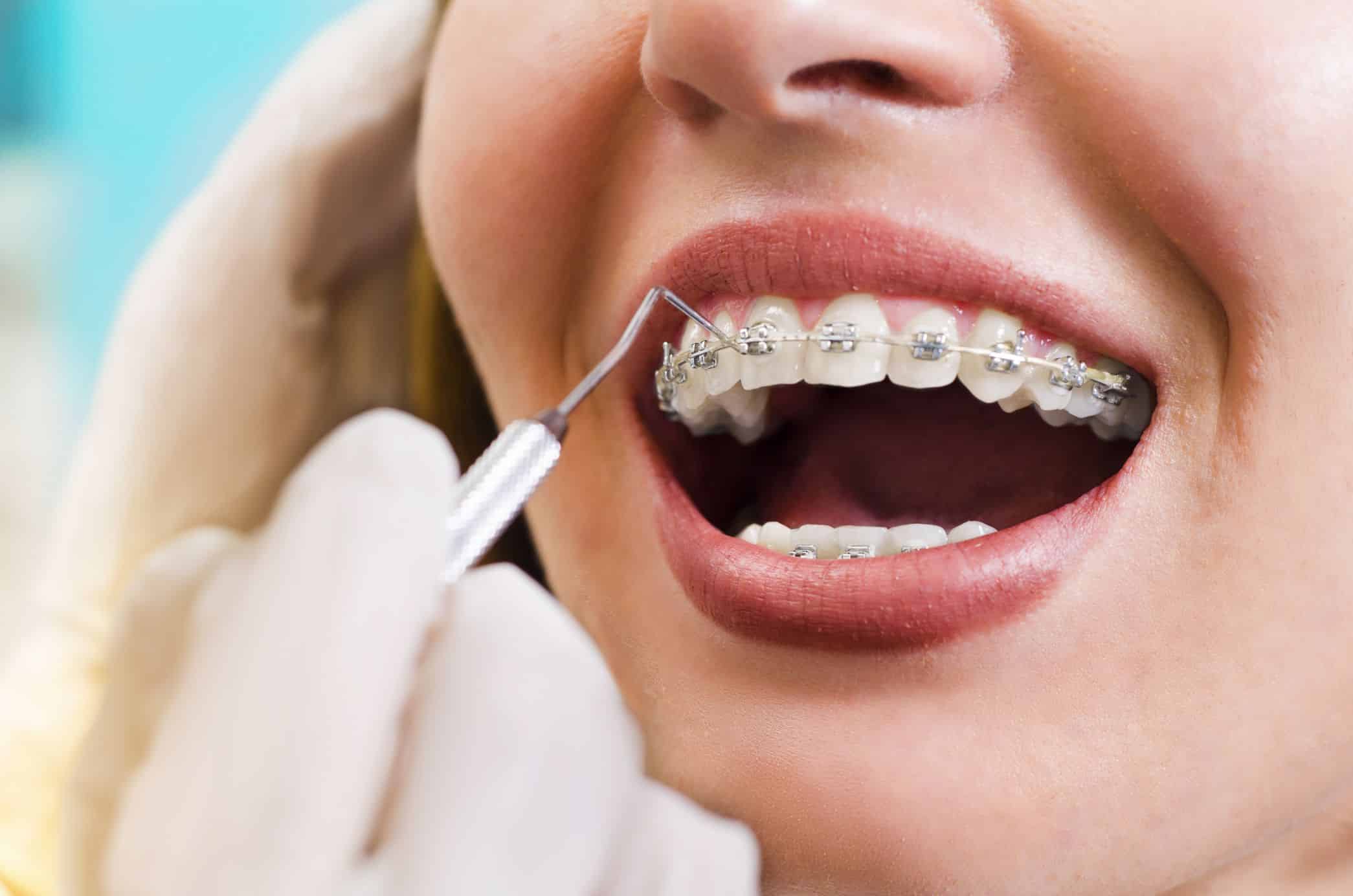 Orthodontics in Toowoomba ​| Braces