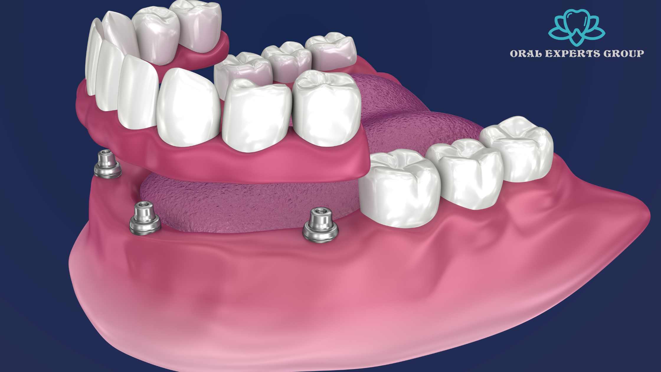 All-On-4 Dental Implants