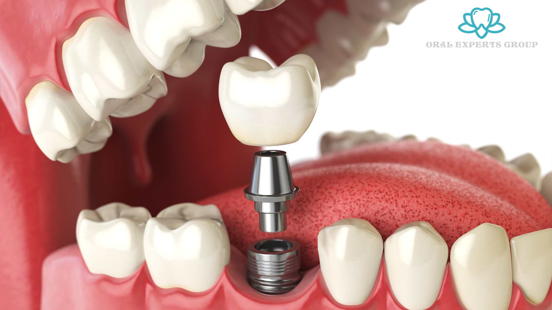 Dental Implants