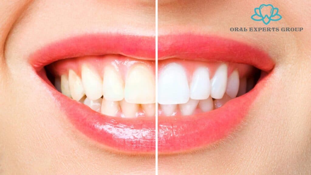 Laser Teeth Whitening