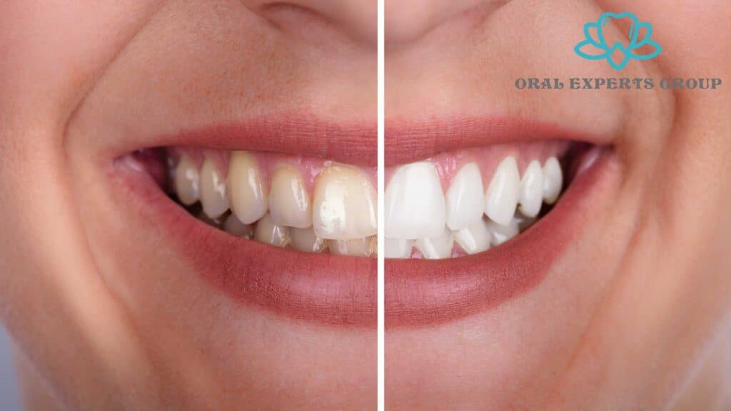 Professional Teeth Whitening