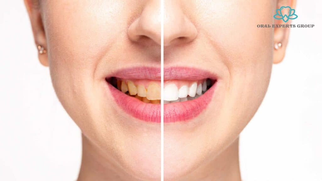 Laser Teeth Whitening Before and After