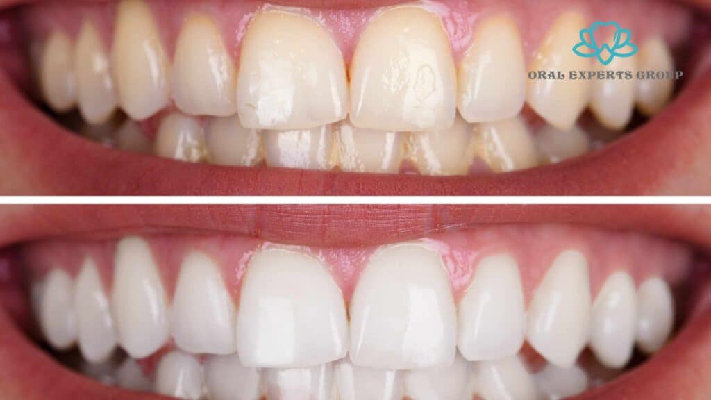 Teeth Whitening