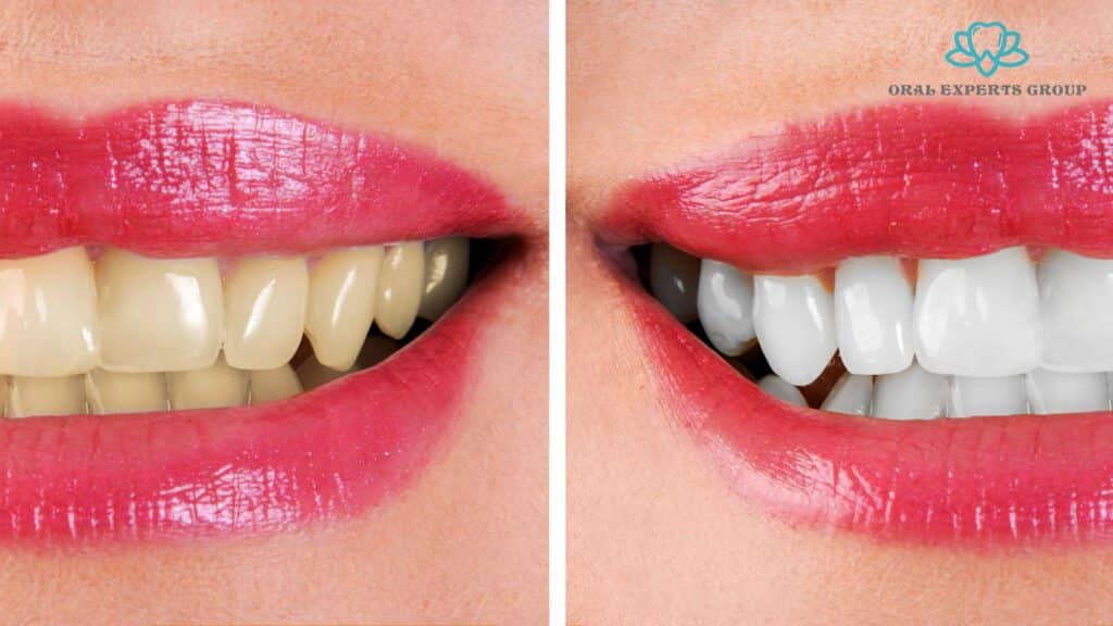 Laser Teeth Whitening Before and After