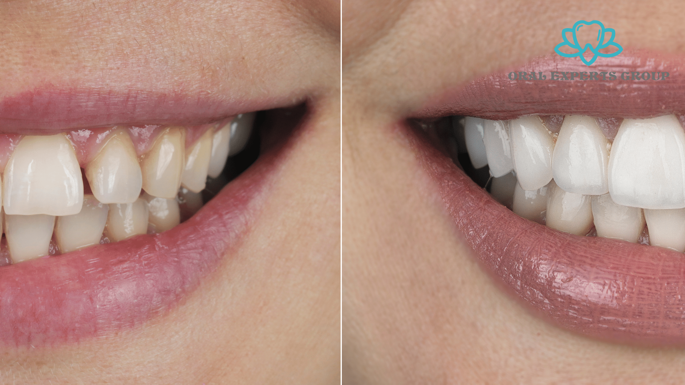 Smile Makeover