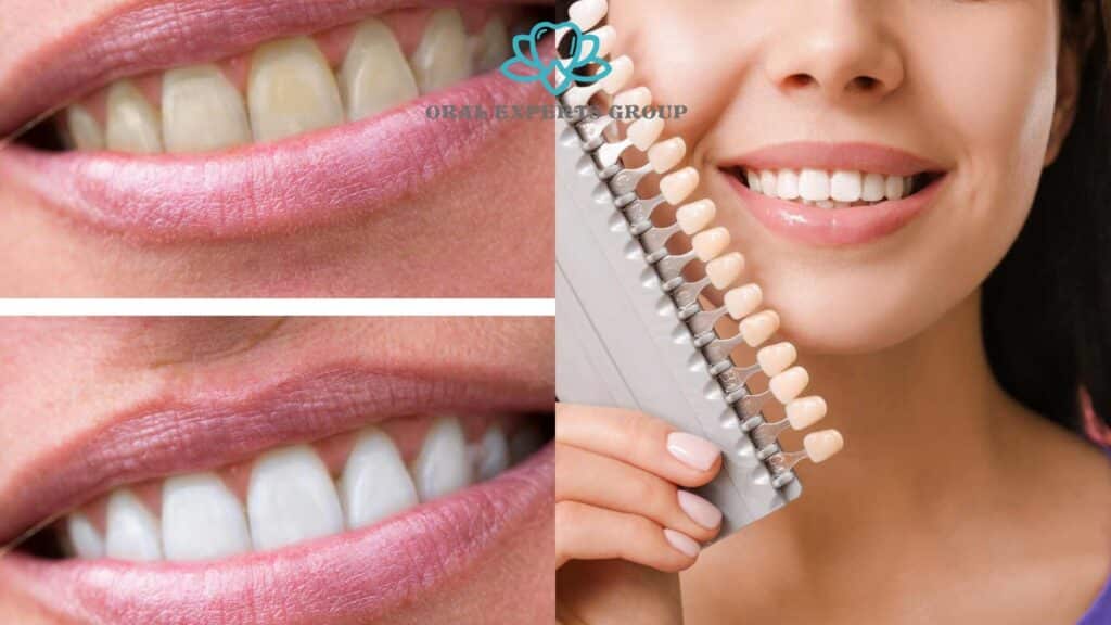 Teeth Whitening vs Dental Veneers