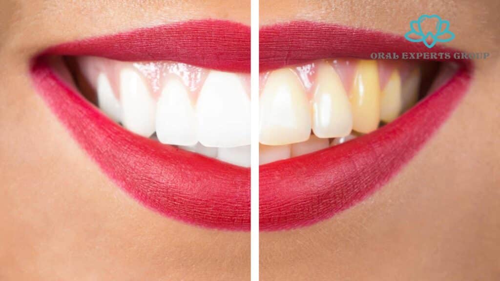  teeth whitening treatments