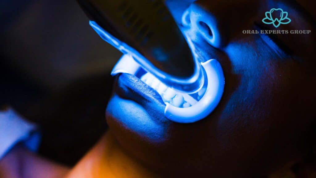 Laser Teeth Whitening