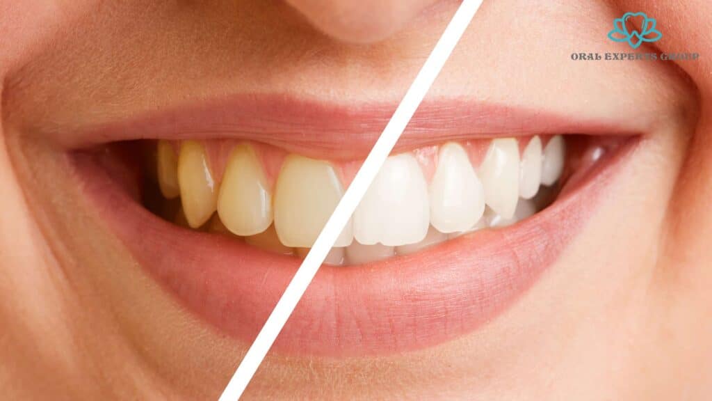 Tooth Whitening Before and After