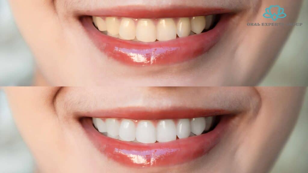 tooth whitening